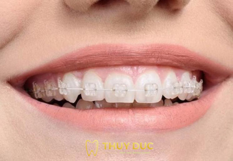 Niềng răng và các phương pháp chỉnh nha mới nhất 2