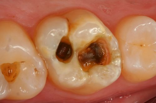 Răng chết tủy là gì? Điều trị răng chết tủy như thế nào? 1