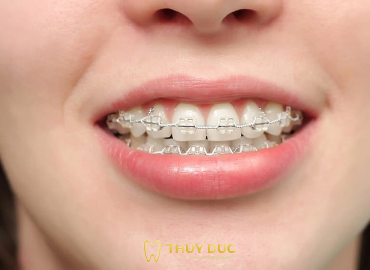 Có khả năng điều trị sâu răng trước khi niềng răng? 
