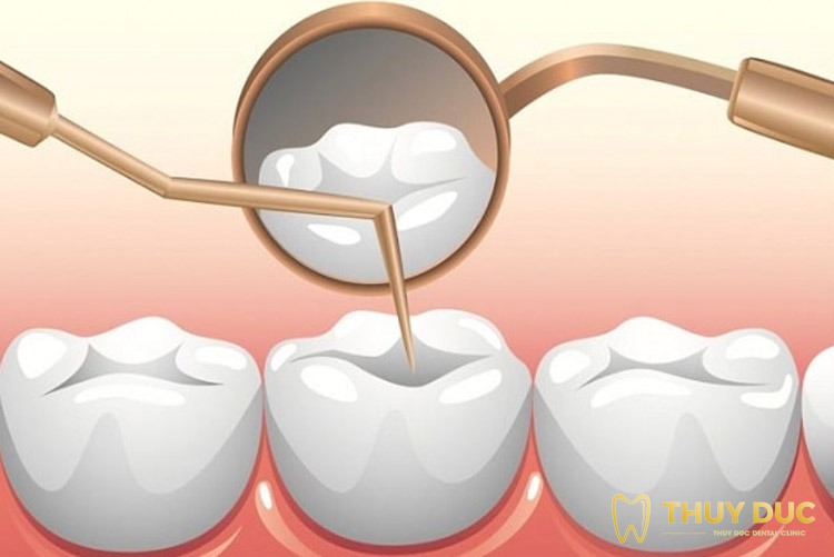 Răng sâu độ 3 chữa trị như thế nào? 1