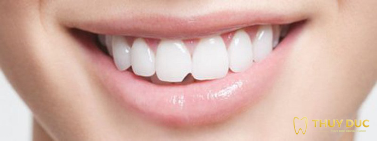 Những tác động tới răng sau khi lấy tủy 1