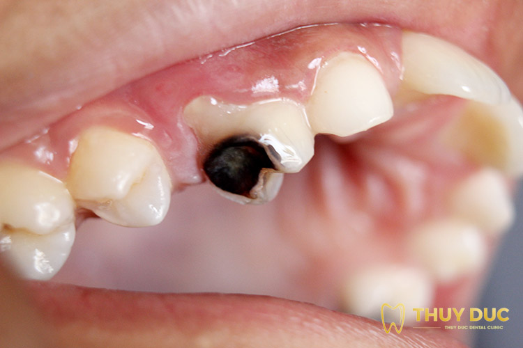 Cách chăm sóc răng miệng cho trẻ nhỏ để tránh sâu răng hàm là gì?
