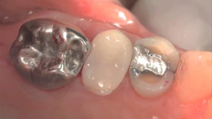Trám răng bằng Amalgam 1