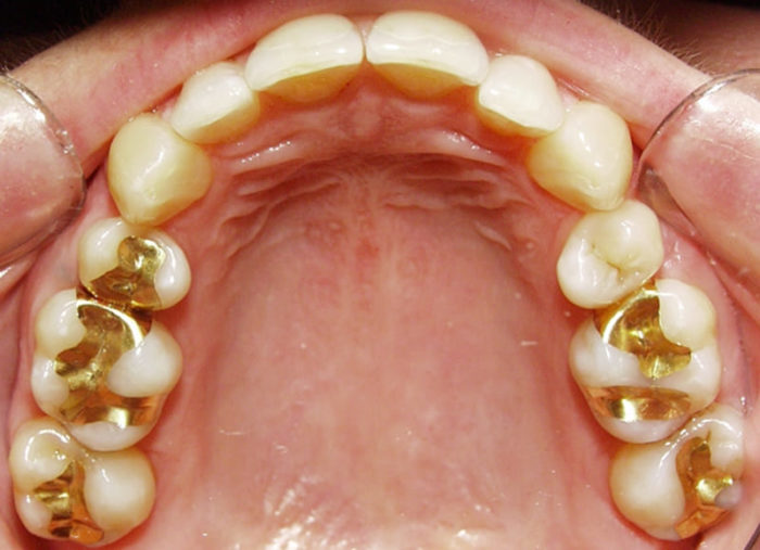 Trám răng bằng vàng 1