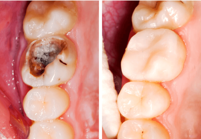 Trám răng là gì? Quy trình trám răng diễn ra như thế nào? 1