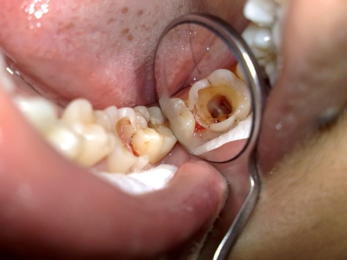 Quy trình trám răng trực tiếp 1