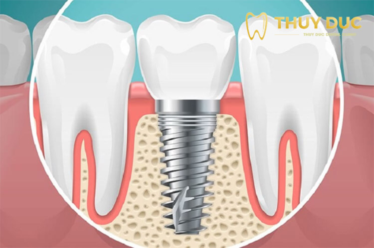 Nên trồng răng implant hay làm cầu răng sứ sau khi nhổ răng? 1