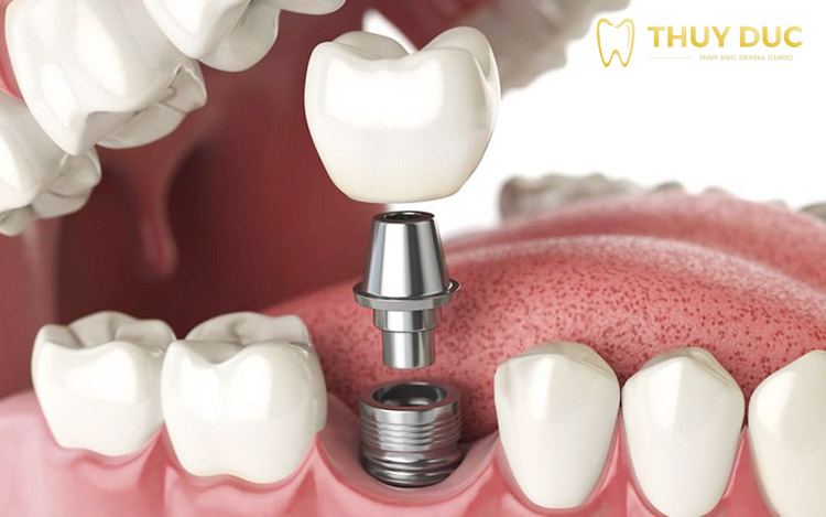 Bọc răng sứ implant là gì? Quy trình thực hiện như thế nào? 1