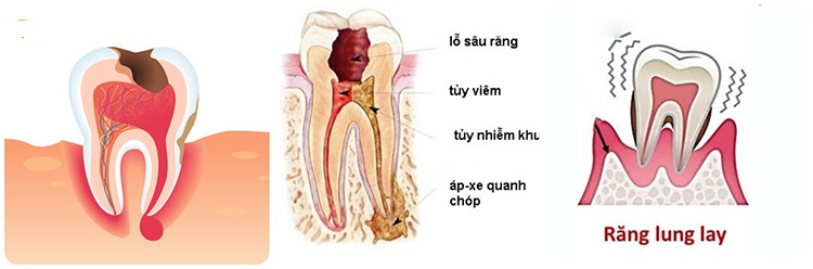 Những trường hợp cần nhổ răng đã lấy tủy 1