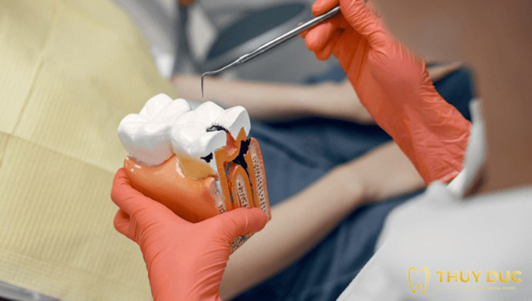 Lý giải vì sao răng sâu vào tủy thường đau nhiều? 1