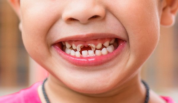 Hàn răng ngừa sâu răng cho trẻ em 1