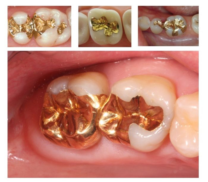 Hàn răng bằng vàng và quý kim 1