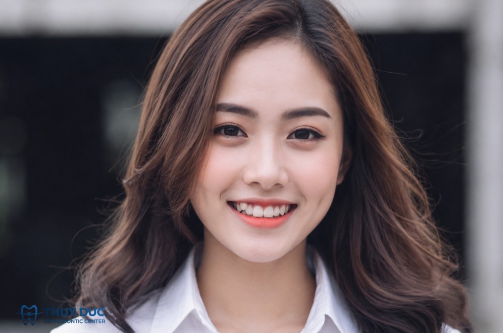 Răng khểnh là răng gì? 1