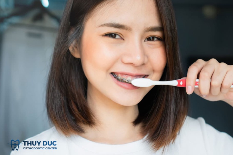 4. Những điều cần lưu ý hạn chế nguy cơ sâu răng khi niềng 1 4. Những điều cần lưu ý hạn chế nguy cơ sâu răng khi niềng 1