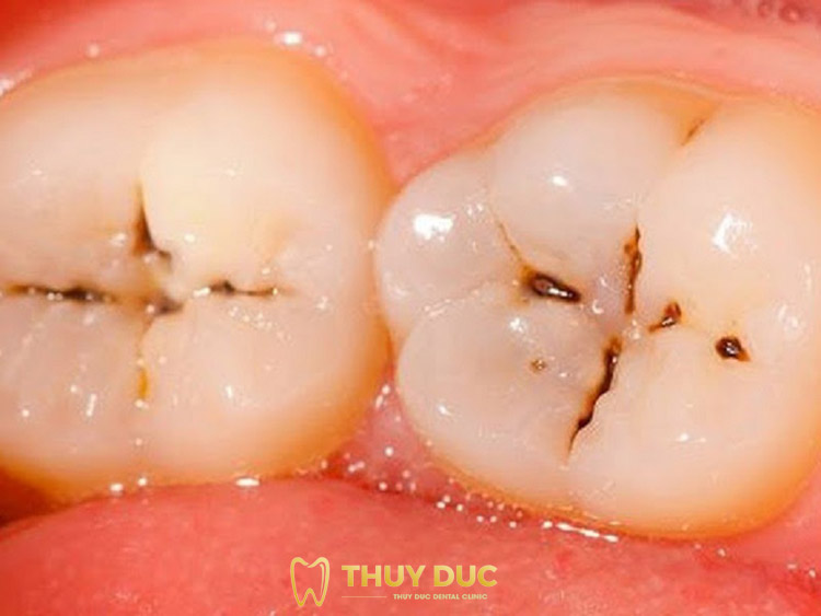 Triệu chứng của sâu răng nhẹ là gì? 1