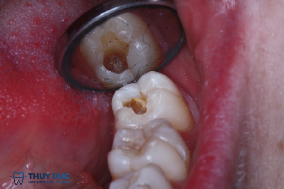 Trẻ bị sâu răng có nên trám không? 1