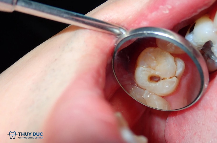 Răng sâu có niềng được không? Câu trả lời chính xác 2 Răng sâu có niềng được không? Câu trả lời chính xác 2