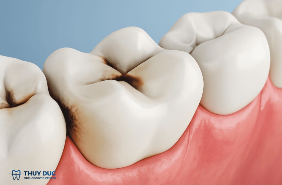Răng sâu có niềng được không? Câu trả lời chính xác 1 Răng sâu có niềng được không? Câu trả lời chính xác 1