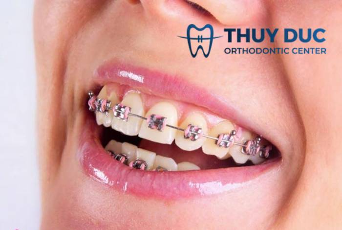 Nên sử dụng sản phẩm chăm sóc răng miệng nào để tránh tình trạng răng bị ố vàng?