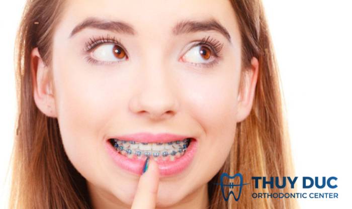 Có nên thực hiện tẩy trắng răng trong khi đang niềng không? 1