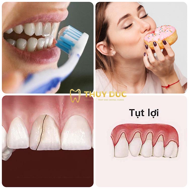 Các nguyên nhân gây sâu răng điển hình nhất 1