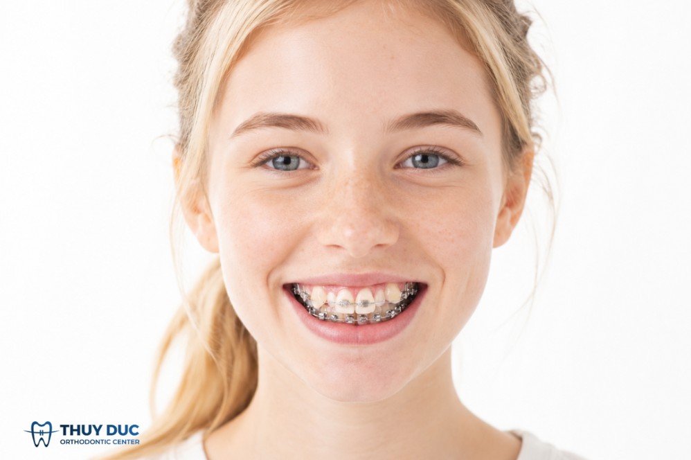 Niềng răng mắc cài truyền thống 1