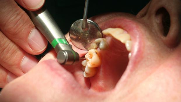 Có nên nhổ răng bị chết tủy không? 1