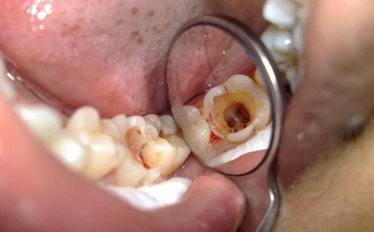 Có nên nhổ răng bị chết tủy? 1