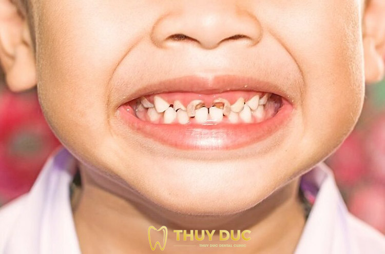 Tình trạng sâu răng ở trẻ em hiện nay 1