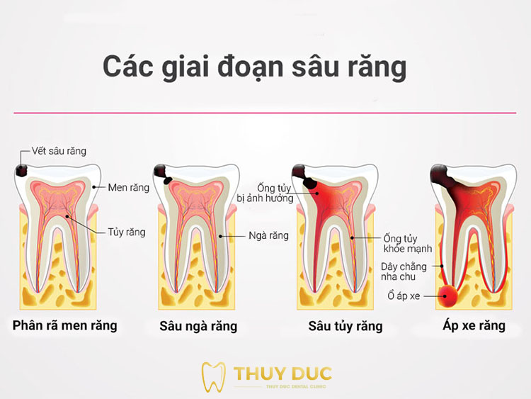 Các giai đoạn phát triển của răng sâu 1