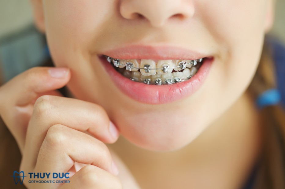 Nguyên nhân nào khiến răng bị ố vàng, xỉn màu khi niềng? 1