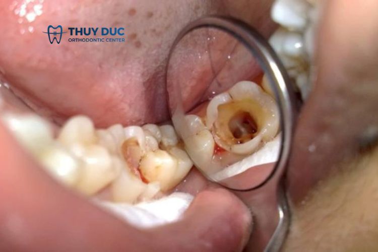 Răng mọc ngầm tại sao cần phải nhổ? 2