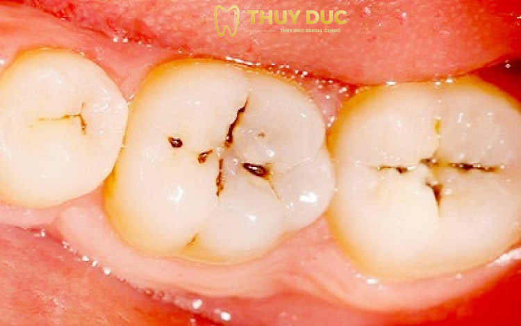 Tìm hiểu cụ thể sâu răng và dấu hiệu nhận biết 1