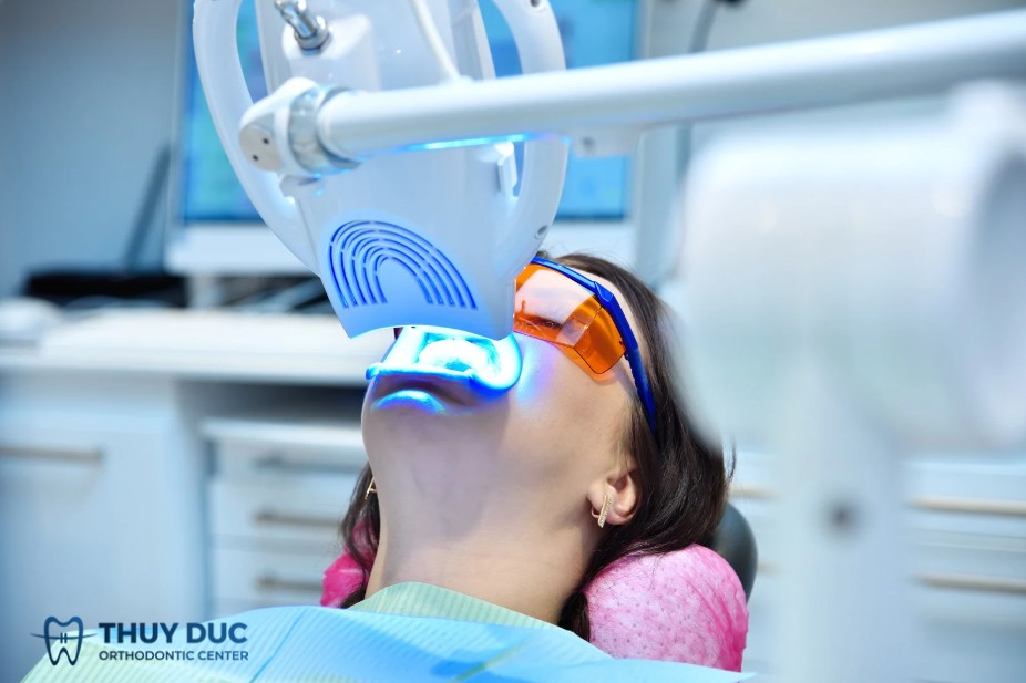 Có nên thực hiện tẩy trắng răng trong khi đang niềng không? 1