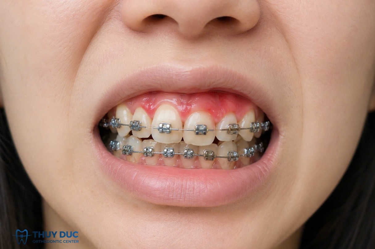 Không vệ sinh đúng cách khi niềng gây ra hậu quả gì? 1