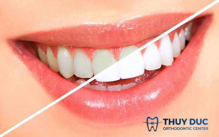 Thuốc tẩy trắng răng tại nhà có hiệu quả như thuốc tẩy trắng chuyên nghiệp hay không? 
