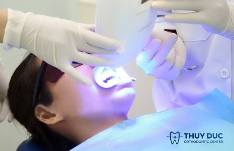 Các phương pháp tẩy trắng răng phổ biến 2