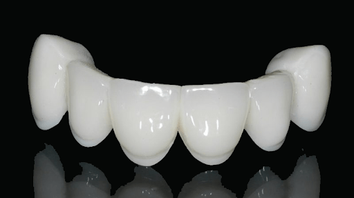 Bọc răng sứ Emax giá bao nhiêu? So sánh giá răng sứ Emax với các loại răng sứ khác 1