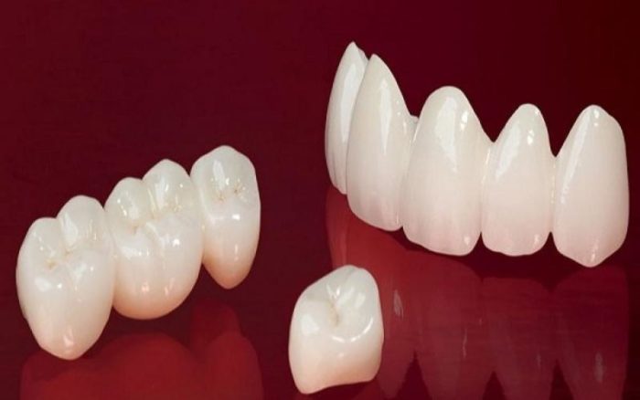 Những lưu ý cần biết trước khi bọc răng sứ Ceramill 1