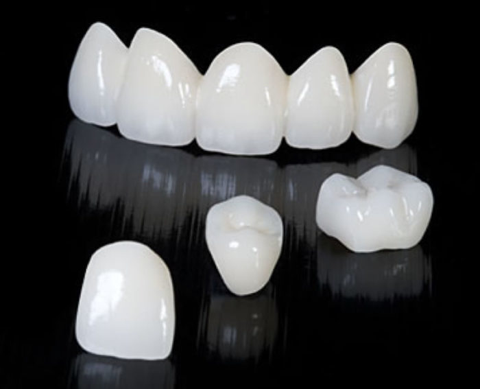 Ưu điểm và nhược điểm của răng sứ Emax 1