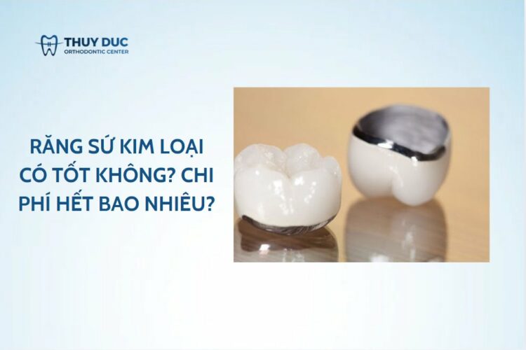 Răng sứ kim loại có tốt không? Chi phí hết bao nhiêu?