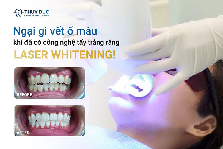 Tẩy trắng răng an toàn, hiệu quả tại nha khoa Thúy Đức 1