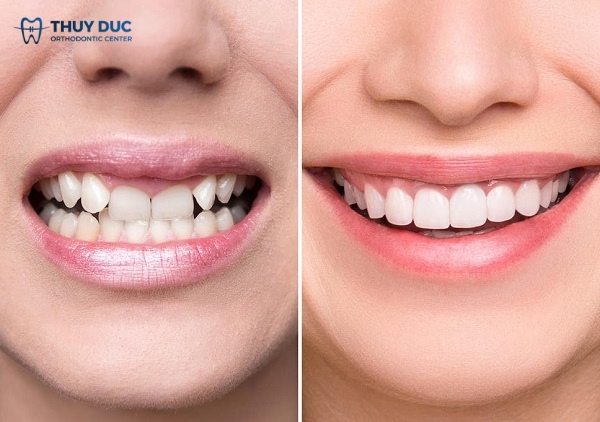 So sánh sự thay đổi trước và sau khi bọc răng sứ đối với răng mọc lộn xộn 1