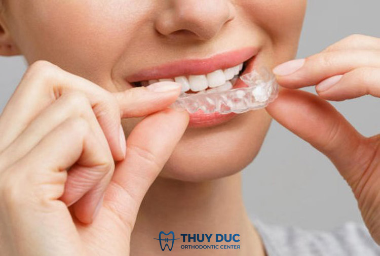 Thời gian sử dụng máng tẩy trắng răng tại nhà cần bao lâu để đạt được hiệu quả tối ưu?
