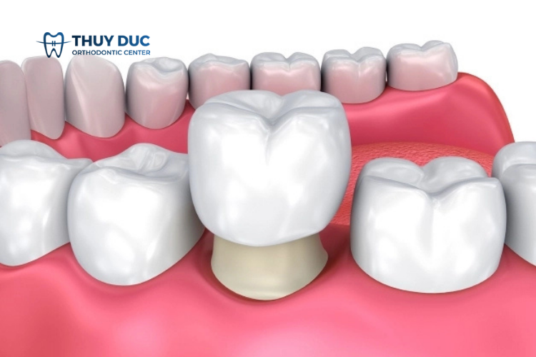 Răng sứ Ceramill giá bao nhiêu? 1 Răng sứ Ceramill giá bao nhiêu? 1