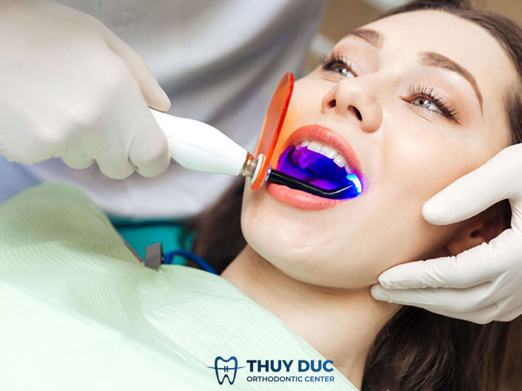 Phương pháp tẩy trắng răng tại nha khoa 1