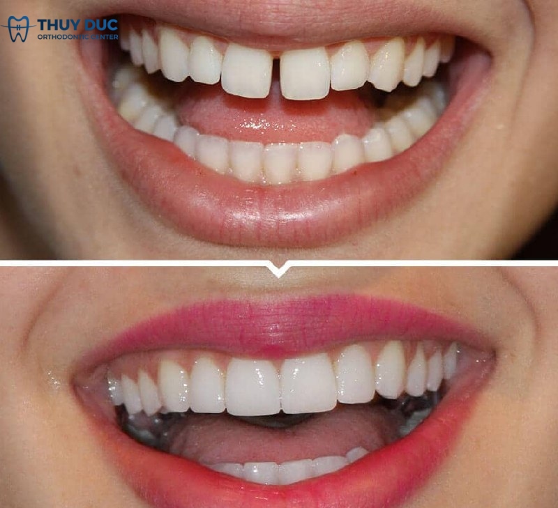 So sánh sự thay đổi trước và sau khi bọc răng sứ đối với răng thưa, hở kẽ 1