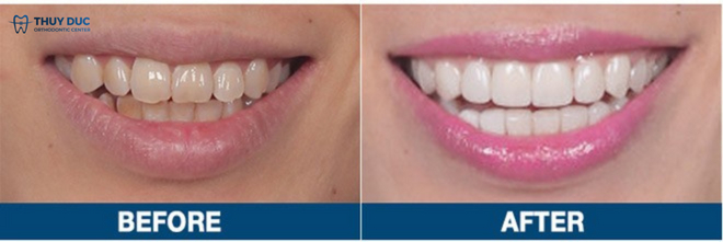 So sánh sự thay đổi trước và sau khi bọc răng sứ đối với răng xỉn màu 1