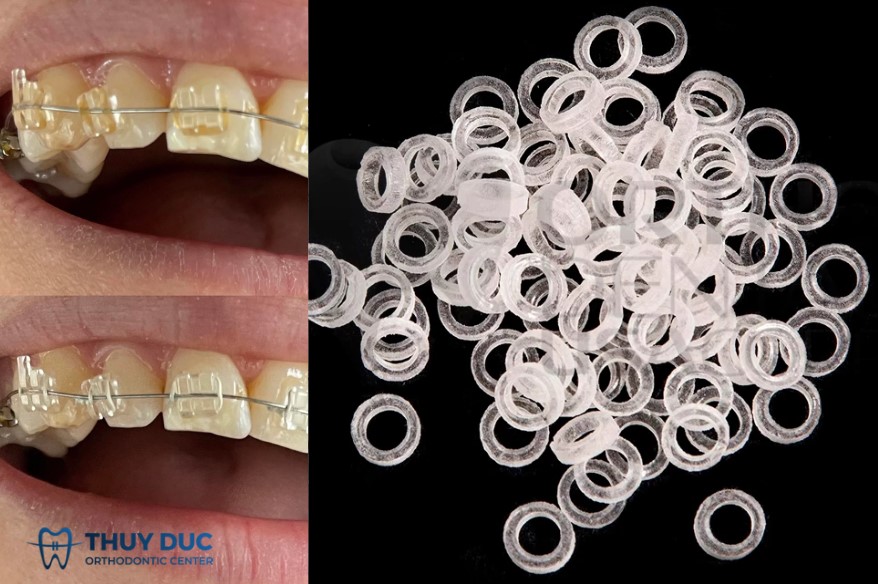 1. Dây thun chỉnh nha có những loại nào? 1