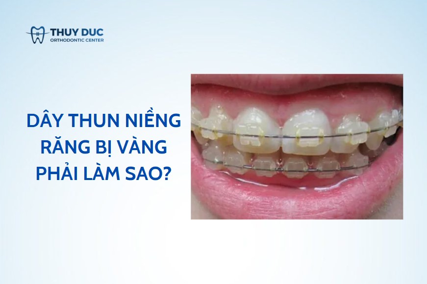 Dây thun niềng răng bị vàng phải làm sao? 1